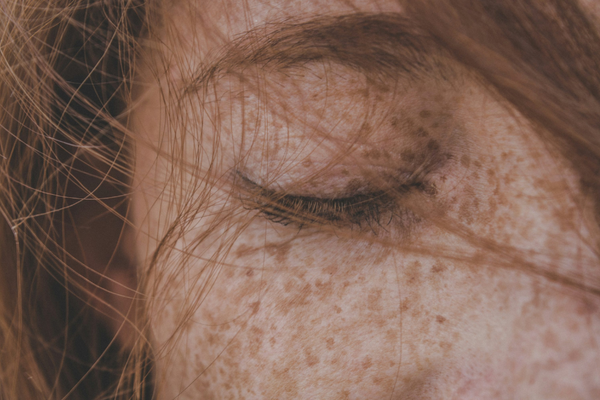 Hyperpigmentation vs Melasma: What’s the Difference and How to Treat It