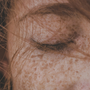 Hyperpigmentation vs Melasma: What’s the Difference and How to Treat It