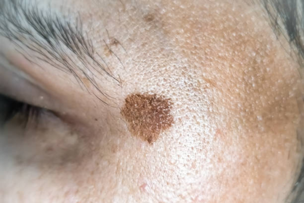 Why Your Dark Spots Aren’t Fading (And What Actually Works)