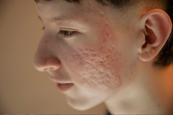 How to Fade Post-Acne Marks Without Damaging Your Skin