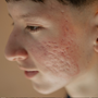 How to Fade Post-Acne Marks Without Damaging Your Skin