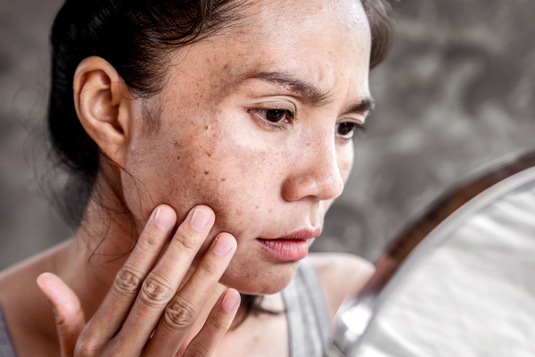 Natural Solutions for Managing Blemish-Prone Skin