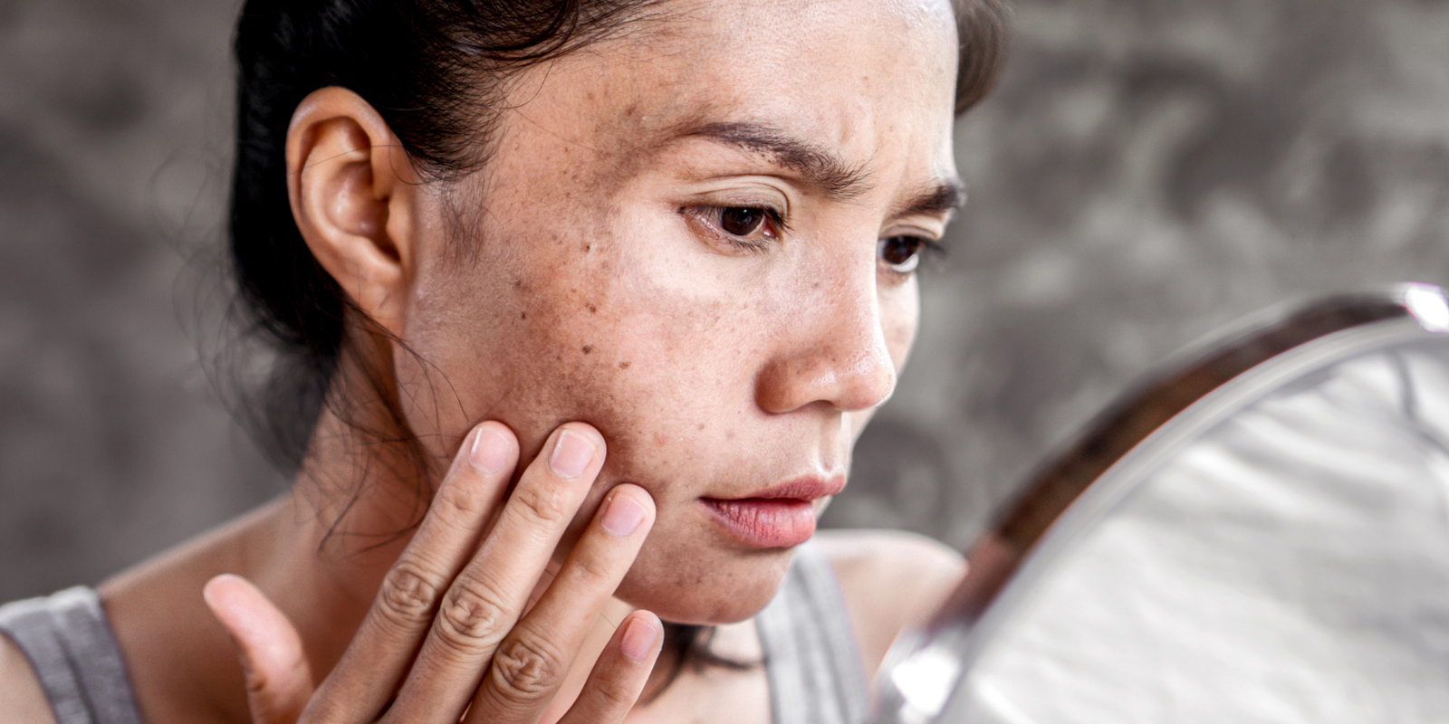 Natural Solutions for Managing Blemish-Prone Skin