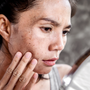 Natural Solutions for Managing Blemish-Prone Skin