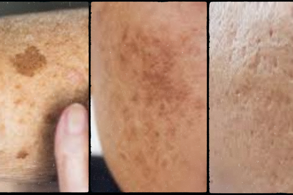 Sun Spots vs. Melasma vs. Acne Marks: How to Treat Each With the Right Routine