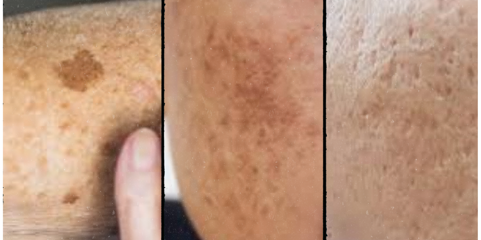 Sun Spots vs. Melasma vs. Acne Marks: How to Treat Each With the Right Routine