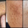 Sun Spots vs. Melasma vs. Acne Marks: How to Treat Each With the Right Routine