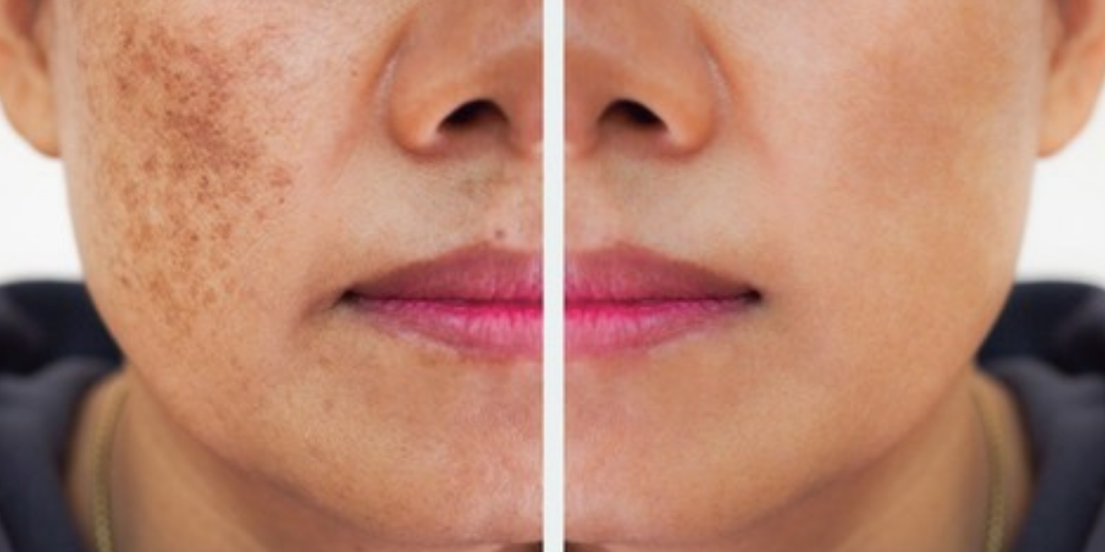 How Long Does It Really Take to Fade Dark Spots? A Realistic Timeline