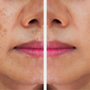 How Long Does It Really Take to Fade Dark Spots? A Realistic Timeline