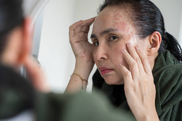 Adult Acne in Your 40s: Why It Happens Even If You Never Had Acne Before