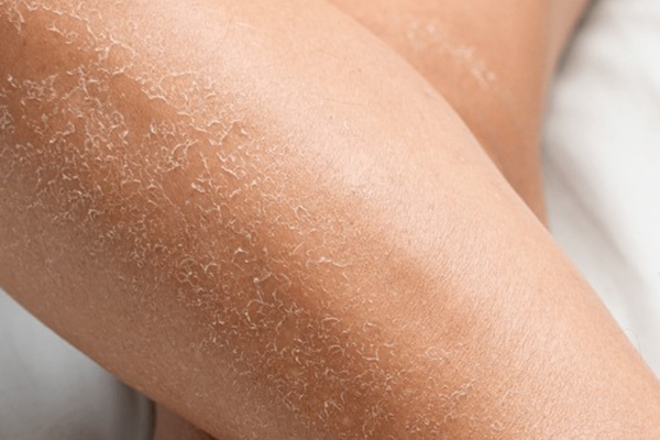 Why Your Skin Is So Dry Lately and What Actually Fixes It