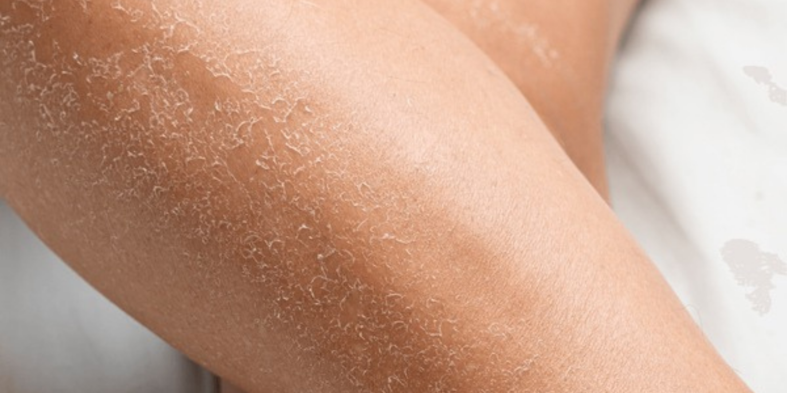 Why Your Skin Is So Dry Lately and What Actually Fixes It