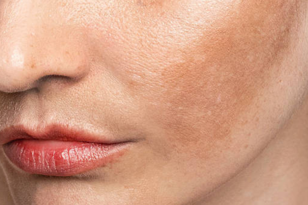 Uneven Skin Tone Explained: Causes, Types, and How to Treat It
