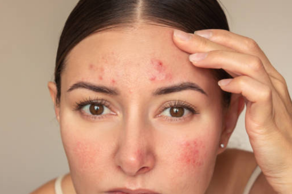 The Best Acne Routine for Sensitive, Aging Skin