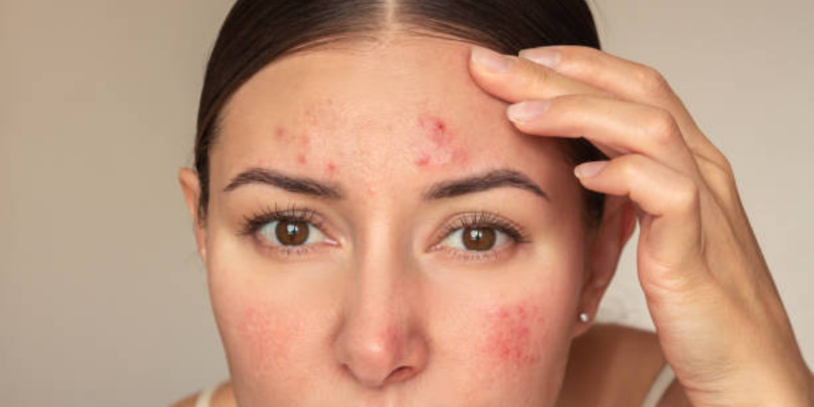 The Best Acne Routine for Sensitive, Aging Skin
