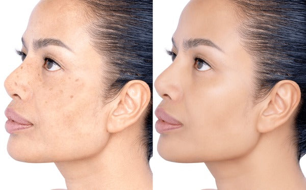 Dark Spots & Sensitive Skin: What Works + What to Avoid