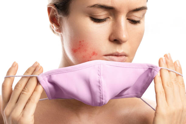 How to Combat "Maskne" Under Your Winter Scarf