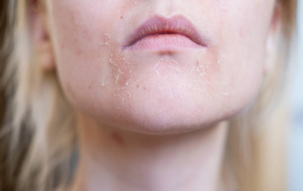 The Ultimate Guide to Treating Dry, Flaky Patches in Cold Weather ...