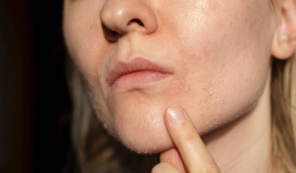 Why Your Skin is Both Oily and Flaky and How to Fix It