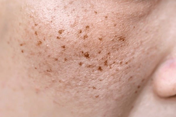 Dark Spot Correction Myths: 5 Mistakes Everyone Makes