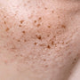 Dark Spot Correction Myths: 5 Mistakes Everyone Makes